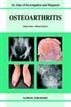 Osteoarthritis