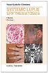 Systemic Lupus Erythematosus