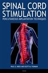 Spinal Cord Stimulation Implantation